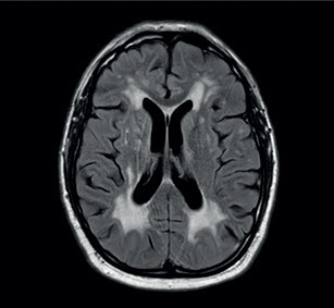 Obr. 2 Vyšetření pomocí MR mozku (T2W), únor 2019: rozsáhlé, splývající a symetrické změny bílé hmoty oboustranně subkortikálně, periventrikulárně a paraventrikulárně, drobné lakuny v bazálních gangliích (do 8 mm) vpravo i vlevo. MR – magnetická rezonance; T2W – T2 vážené obrazy
