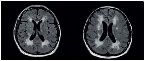 Obr. 4 Porovnání výsledků vyšetření pomocí MR mozku z února 2019 (vlevo) a z ledna 2020 (vpravo): výrazné splývající gliózy v bílé hmotě oboustranně, patrna mírná progrese. MR – magnetická rezonance