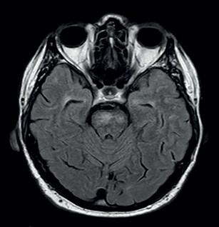 Obr. 5 Vyšetření pomocí MR mozku (FLAIR), červen 2021: chybějící gliózní léze temporálně, což je typické pro CADASIL. MR – magnetická rezonance