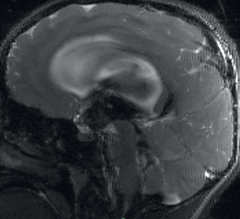 Obr. 2 Na PSIF sekvenci MR patrný výrazný tokový artefakt likvoru přes aquaeductus mesencephali. PSIF – sekvence určená k detekci toku likvoru (posterior spinal instrumentation and fusion); MR – magnetická rezonance