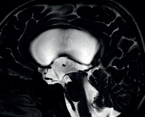 Obr. 6 3D CSF Drive sekvence MR mozku – viditelný je tmavý tokový artefakt přes dno III. komory v místě endoskopicky provedené stomie. CSF – mozkomíšní mok (cerebrospinal fluid); MR – magnetická rezonance