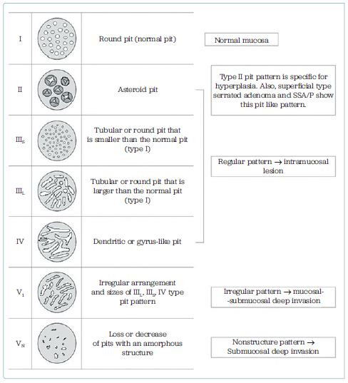 Obr. 2 Kudova „pit pattern” klasifikace využívající kombinaci chromoendoskopie a zvětšovací endoskopie k popisu uspořádání ústí krypt v závislosti na biologickém chování léze Převzato z: Tanaka S, et al. High‑magnification colonoscopy (with videos). Gastrointest Endosc 2006;64:604–613. doi:10.1016/j.gie.2006.06.007