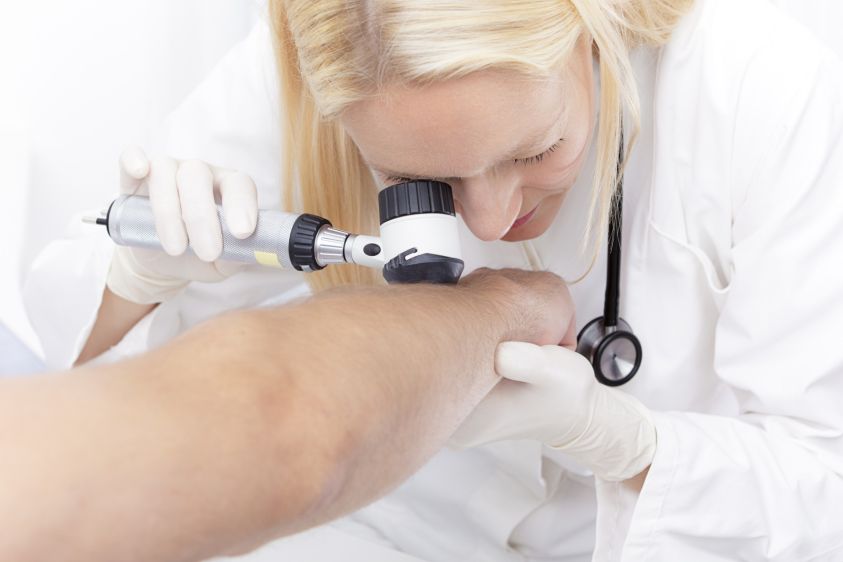 iStock-504707883_dermatoskopické vyšetření, melanom