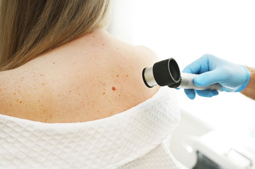 a dermatologist examines moles and skin growths on the patient2700s body using a special device - a dermatoscope2e00 Diagnosis and prevention of melanoma2e00