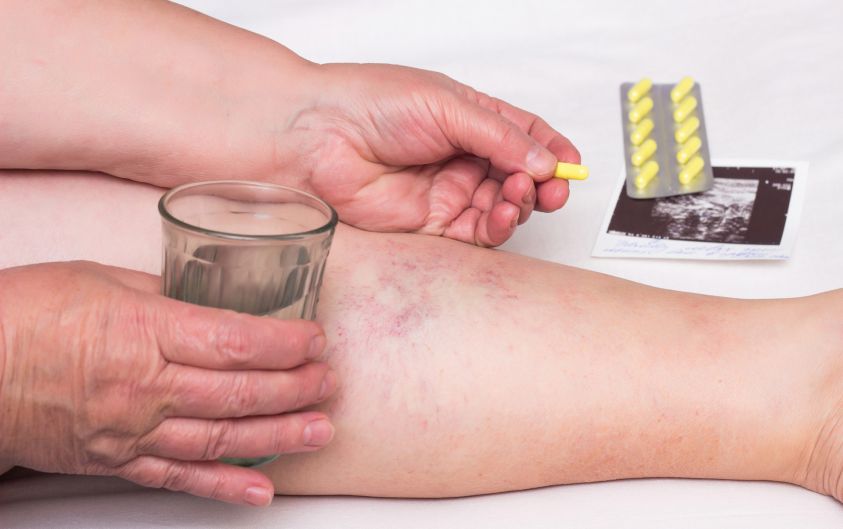 Old woman holding a glass of water and a pill for varicose veins on the background of the legs with varicose veins, close-up