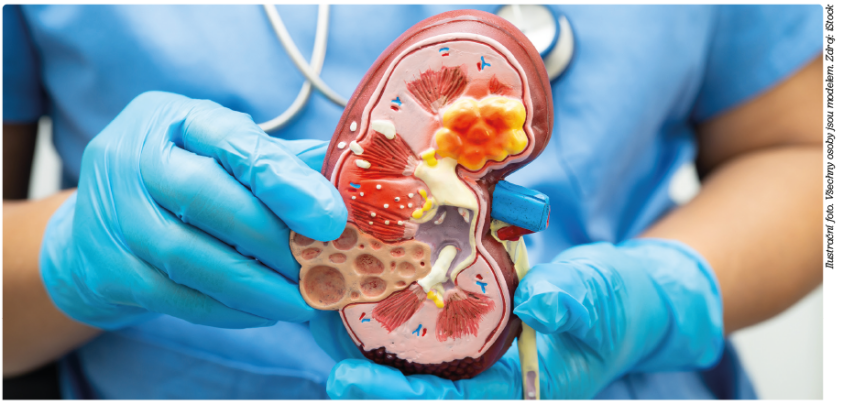 Glomerulární onemocnění