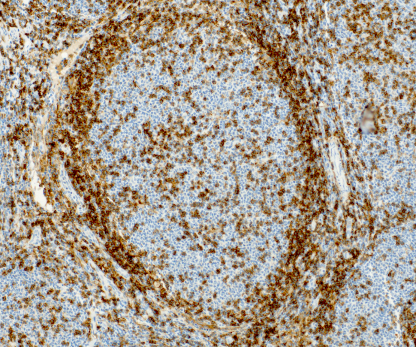 04-JANA1 Mraz_lymfom